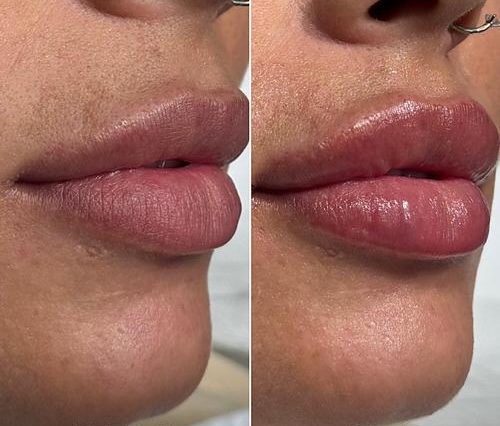 Tratament acid hialuronic buze Timișoara