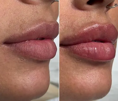 Tratament acid hialuronic buze Timișoara