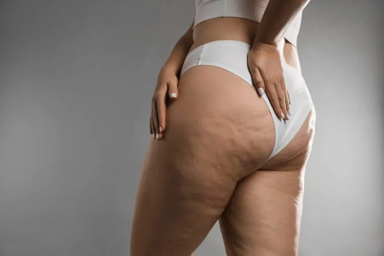 Celulita
