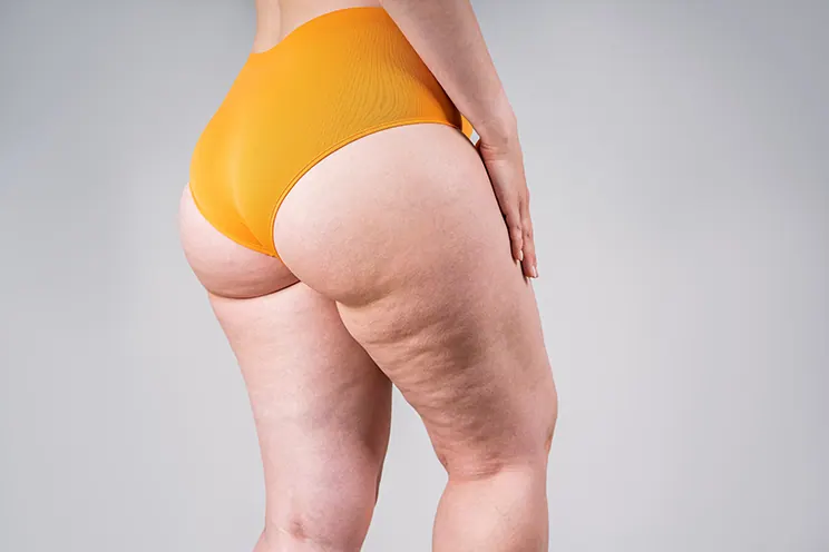 Celulita