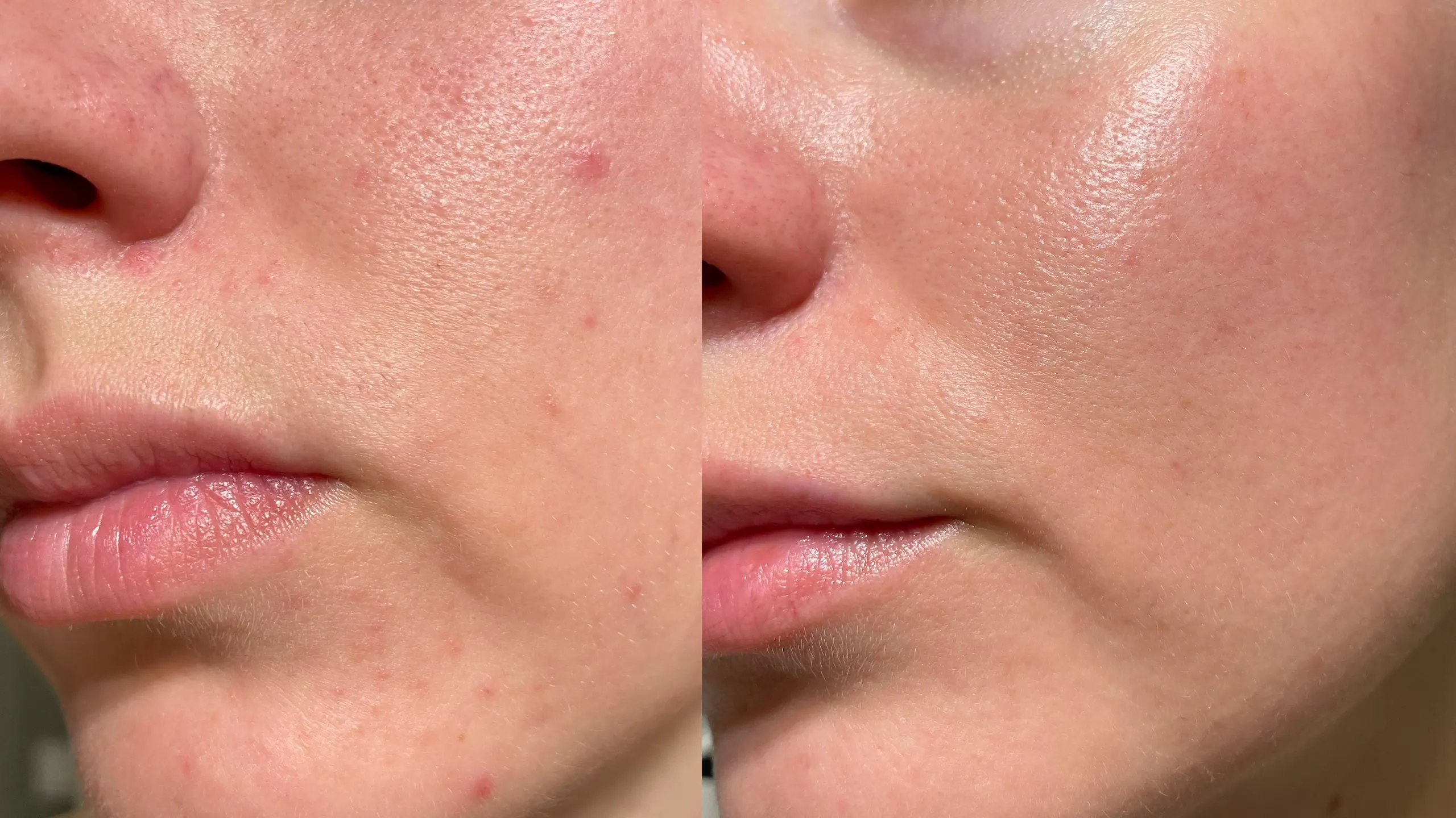 Tratament Lanluma Sculptra biostimulare colagen