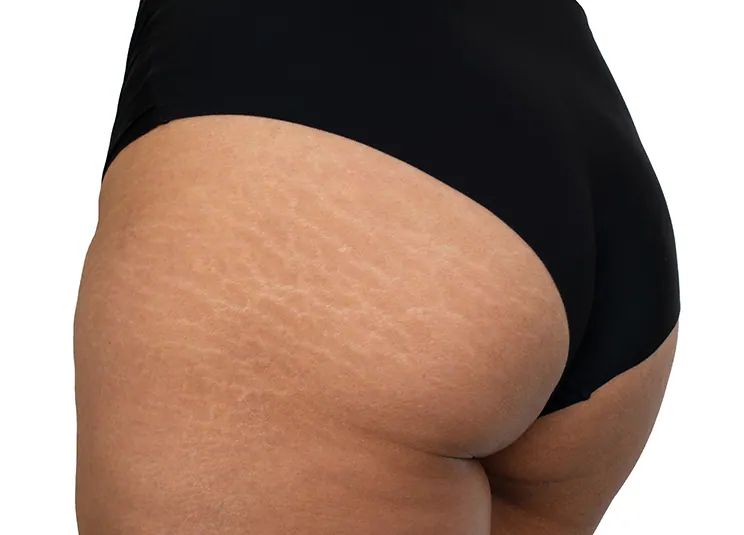 Vergeturi After Treatment